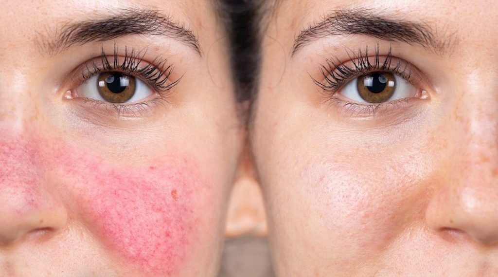 Skin with rosacea on the left and after treatment on the right. These are not results from exfoliation alone but a combination of other treatments.